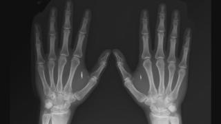 Türk Iron Man Tolga Özuygur derisinin altına çip yerleştirdi